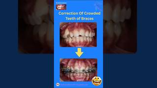 Correction of Crowded Teeth of Braces #Fixed Orthodontic Treatment /@thebracesdoctor