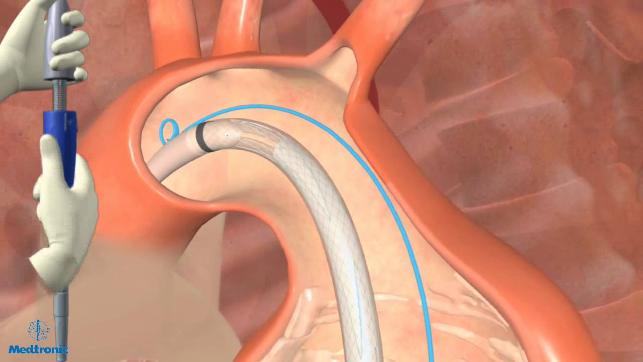 Thoracic Endovascular Aortic Aneurysm Repair In Dallas Youtube