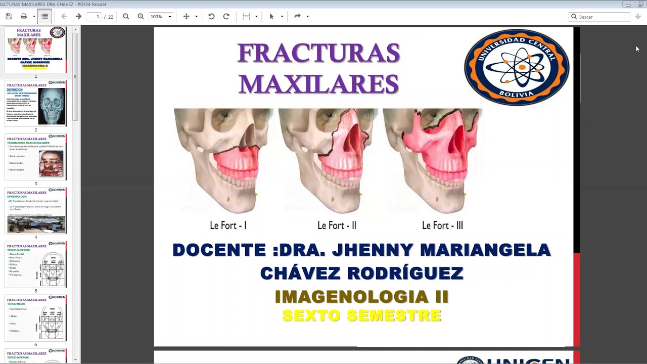 Fracturas Maxilares: Qué Es, Síntomas Y Tratamiento – MWPGLA