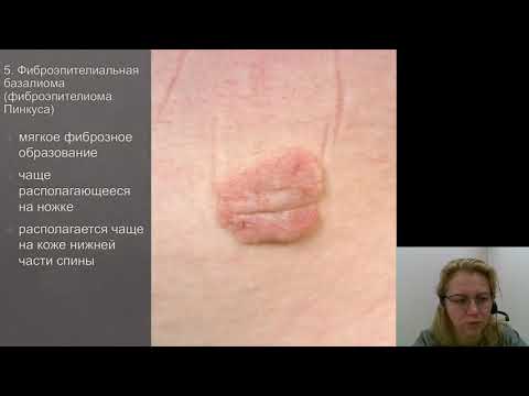 Video: Rak Kože (adenokarcinom) Kod Pasa