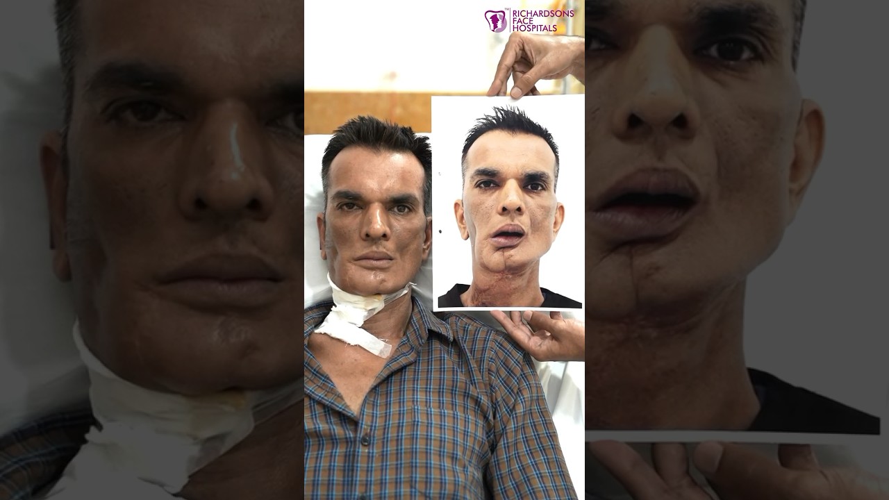 Post cancer reconstruction #oralcancer