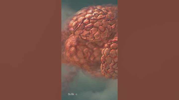 Pneumonia Explained