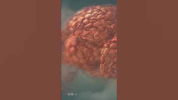 Thumbnail of Pneumonia Explained
