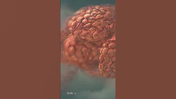 Pneumonia Explained 