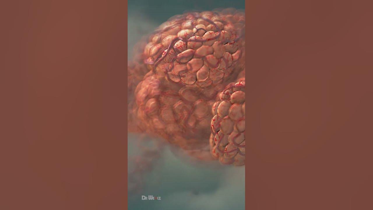 Pneumonia Explained