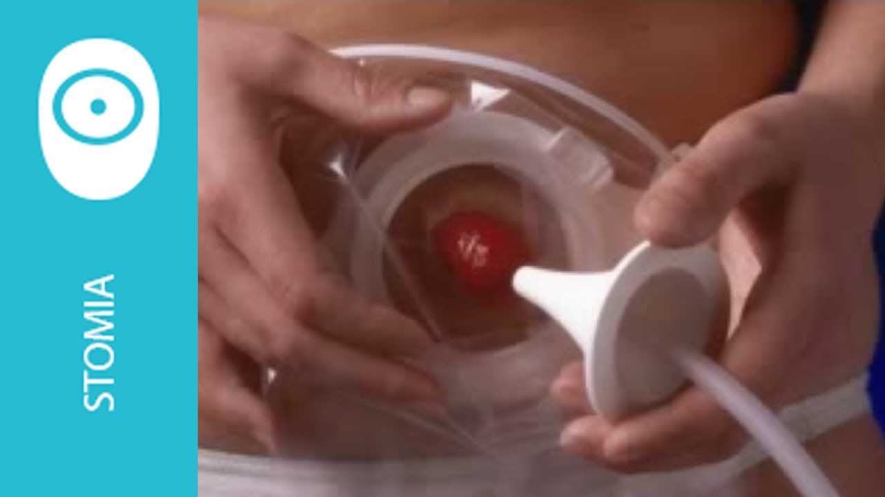 dieta morbida dopo operazione al colone dieta morbida dopo operazione al colone