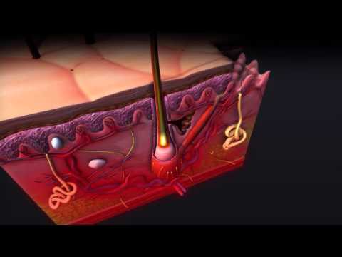 Video: 5 Langkah Merawat Pendarahan Dan Fisura Psoriasis