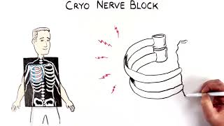 Cryo Nerve Block Patient Animation
