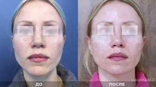 До и после хейлопластики у доктора Вакориной Е.И. Последствия неудачной операции по увеличению губ.