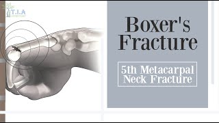 การแตกหักของกระดูกฝ่ามือชิ้นที่ห้า - Boxer's Fracture (มีคำบรรยาย)