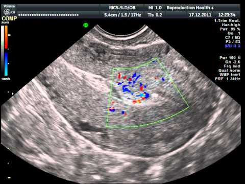 Лохиометра это. Пузырный занос УЗИ картина. Остатки плацентарной ткани на УЗИ. Остатки плацентарной ткани после родов на УЗИ.