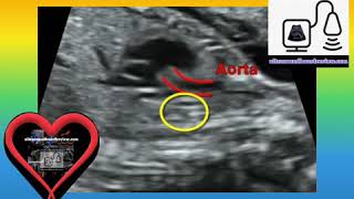 Interrupted Aortic Arch