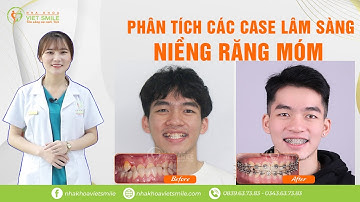 Niềng răng móm - Phân tích 2 case lâm sàng