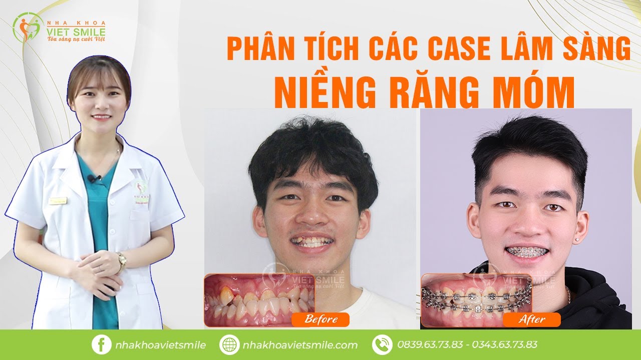 Tất Tần Tật Những Kiến Thức Về Răng Trẻ Em Bạn Cần Biết