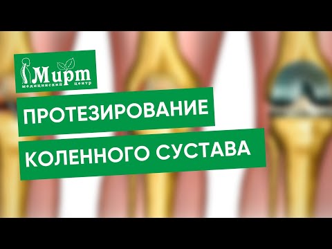 Эндопротезирование коленного сустава. Замена коленного сустава. Операция на колене по ОМС.