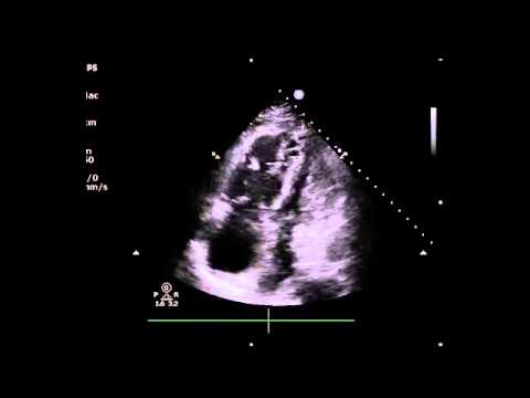 ultrasound podcast us in massive pe case with em resus youtube