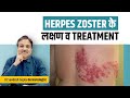 Herpes Zoster Symptoms and Treatment. Dr Sandesh Gupta. 99908 04085