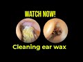 귀지 청소,귀지 청소 내시경,귀지 청소기 Ear  Wax Cleaning | ASMR Ear Wax