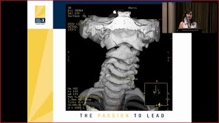 Atlantoaxial (C1- C2) Subluxation in the Pediatric Population screenshot 5