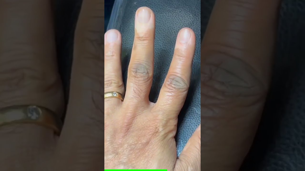 Vitiligo Permanent Treatment Machu Tattoos Indra Nagar Bangalore