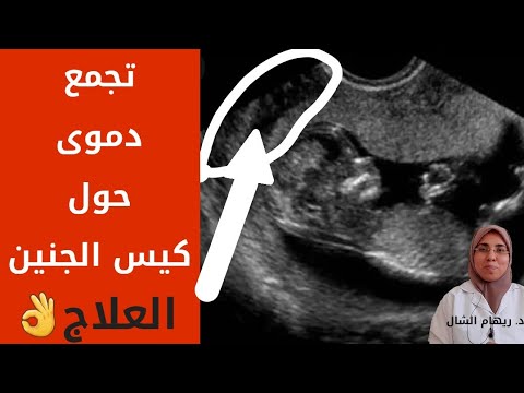 ما معنى وجود تجمع دموى حول كيس الجنين انفصال المشيمة الجزئى د ريهام الشال