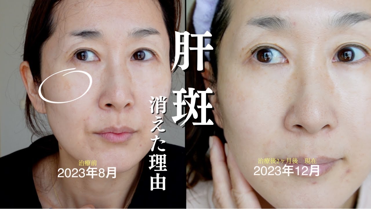 【肝斑は消える】しみが無くなった最大の理由を公開！プロの説明もあり〼✨
