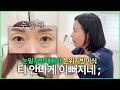 티 안나게 이뻐지는 성형수술 👀눈밑지방재배치, 눈위지방이식 후기!