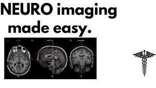 Neuroanatomy on MRI | Part 1| Cerebrum, Basal Ganglia, Thalamus, Internal Capsule & Lesions