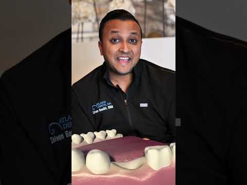 Dental Implant vs. Bridge | Which is the BEST option for you?