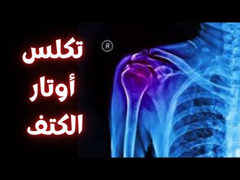 التهاب الاوتار التكلسي تكلس اوتار الكتف تكلس الكتف تكلس الكتف المؤلم علاج تكلس اوتار الكتف الم الكتف