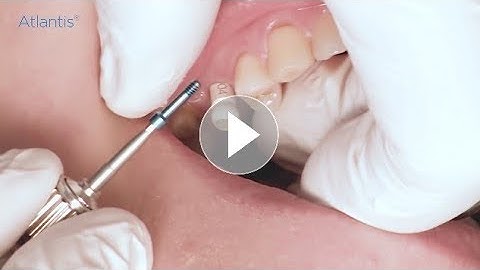 Atlantis CustomBase solution using intraoral scanning