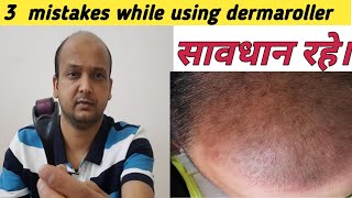 Don't Do these 3 mistakes while using  dermaroller and Neo hair lotion