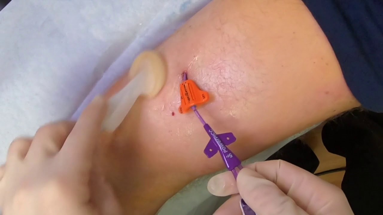 biopatch central line dressing BIOPATCH CHG: Reduce the risk of infections | Ethicon