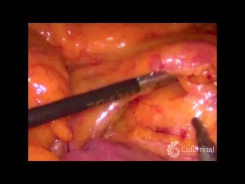 Colectomia total com anastomose ileorretal por videolaparoscopia