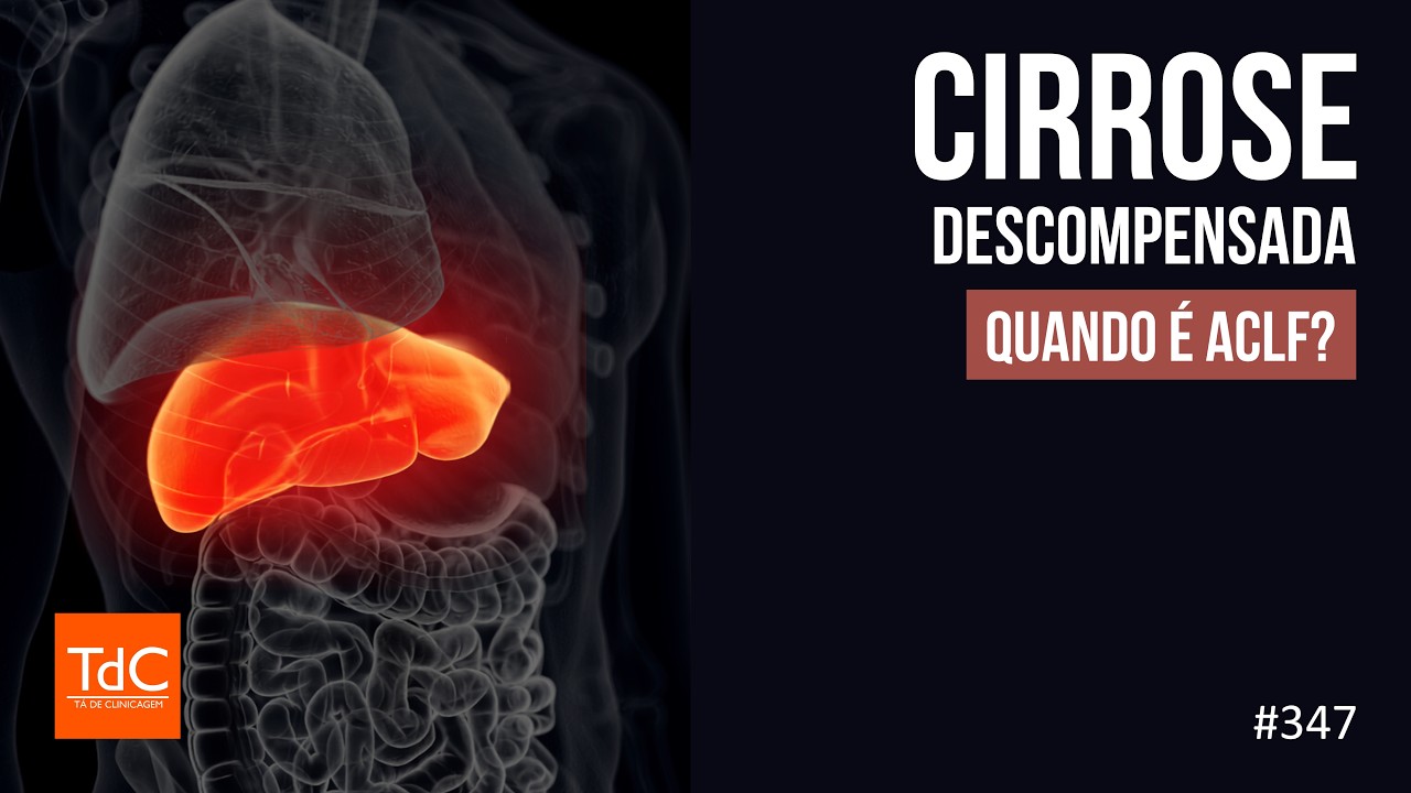 Thumbnail - Episódio 347 - Cirrose Descompensada: Quando é ACLF?