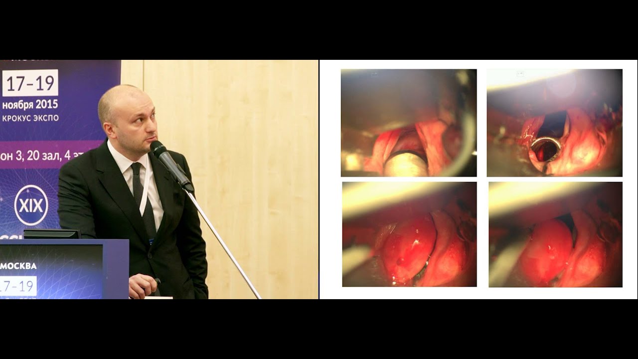 Эндоларингеальные лазерные резекции в лечении рака гортани Т1-Т2