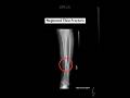 Neglected Tibia Fracture Corrected with Osteotomy and Titanium Rod
