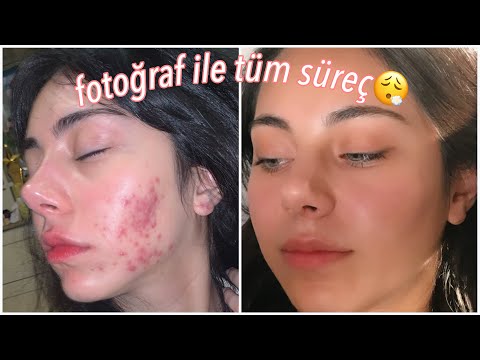 Fotoğraflı Roaccutane Sürecim🥵🧖🏻‍♀️ Sivilce Tedavisi✨