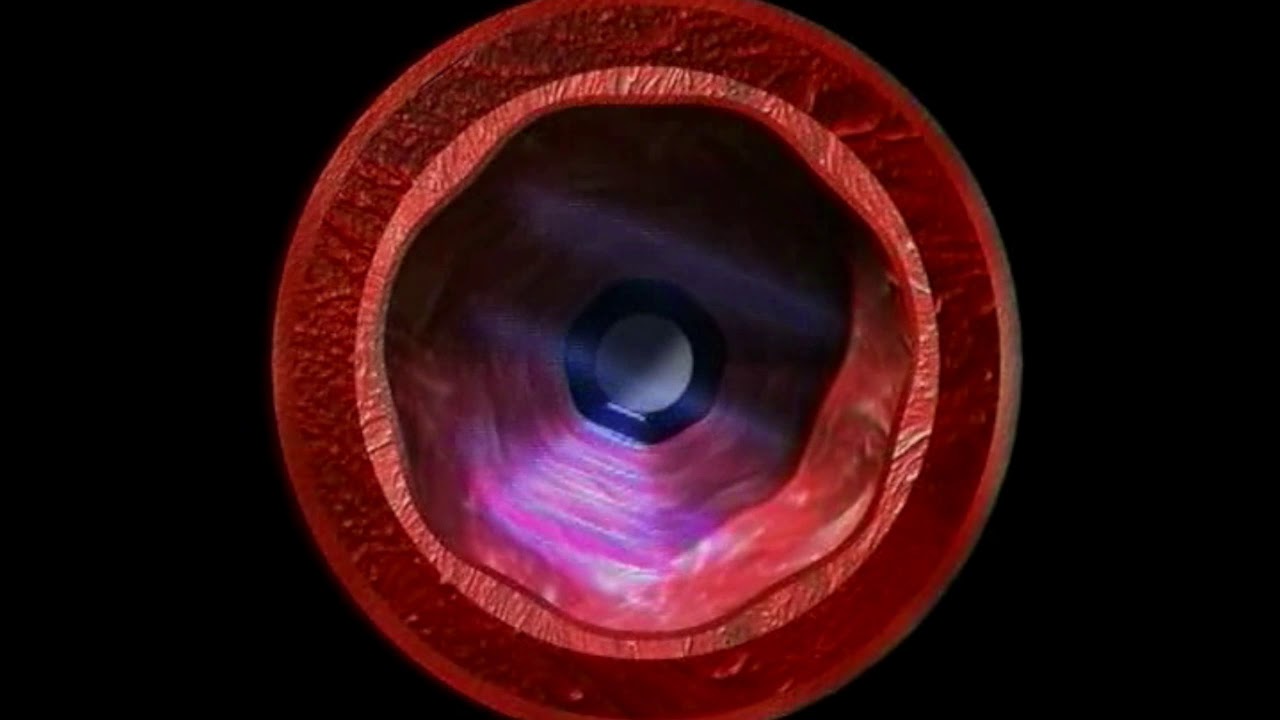 IVUS Technology Explanation