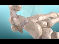 Carpal instability disi and visi deformity 3d