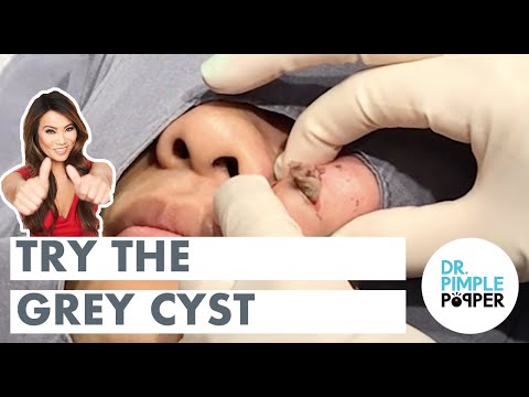 Try the Grey Cyst