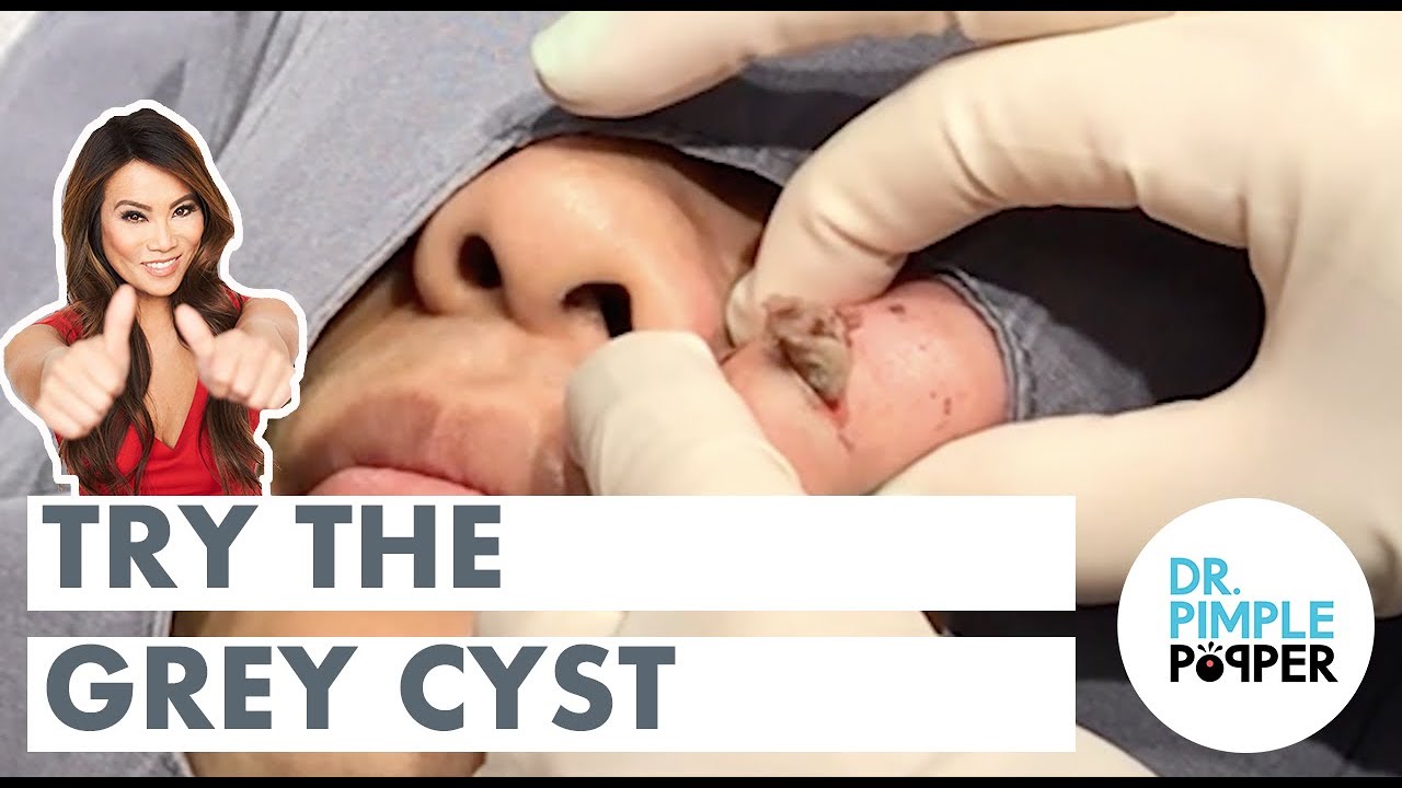 Download Try the Grey Cyst