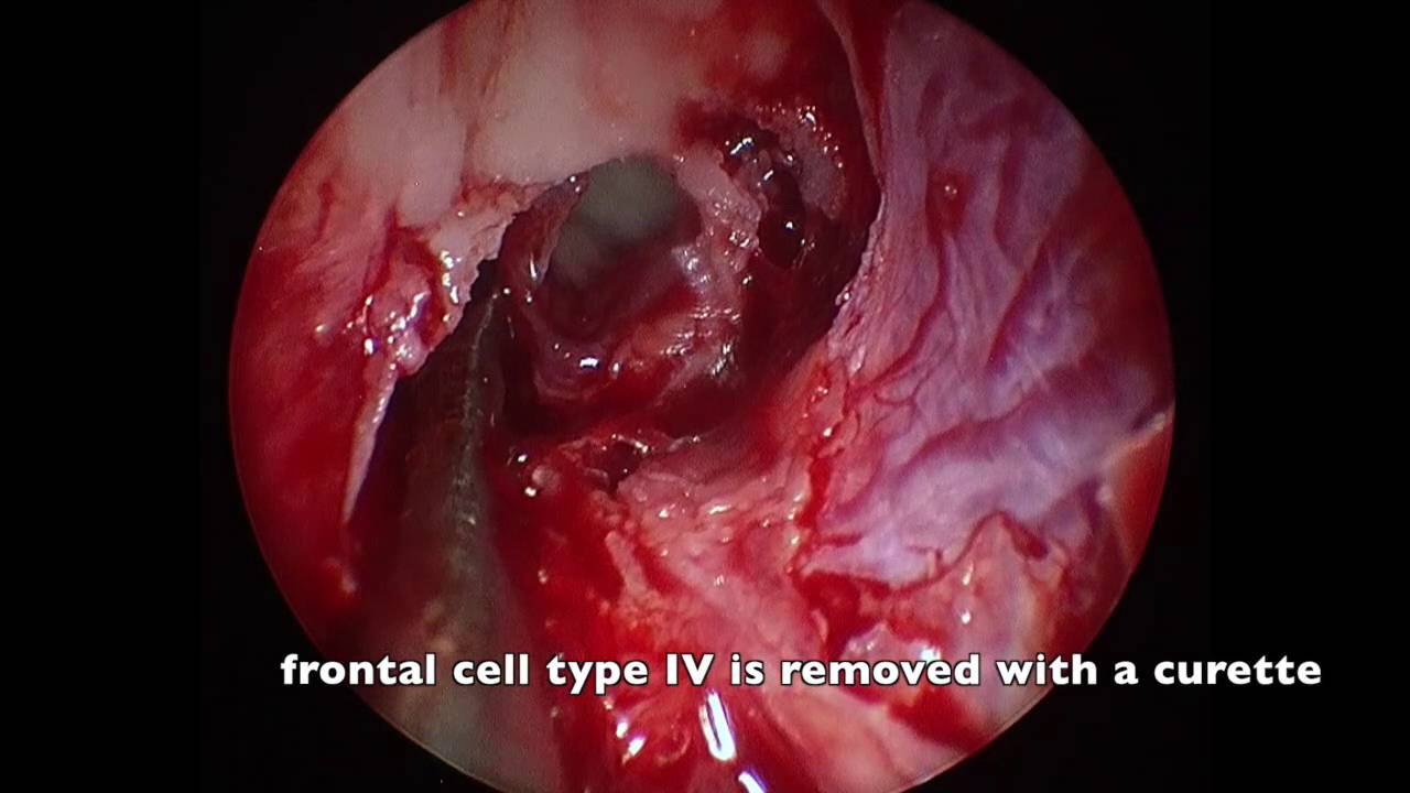 Endonasal Frontal Sinus Drainage Type Iiii According To Draf