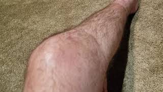 Missing ACL Demonstration