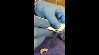 Lateral Crural Overlay Technique For Nasal Tip Modification in Rhinoplasty