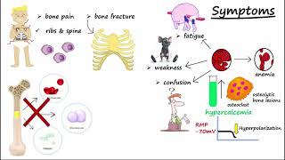 Multiple Myeloma