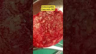 #case #num #363 #osteomylitis #rims #mch #neurosurgery #drsourabhneurosurgeon