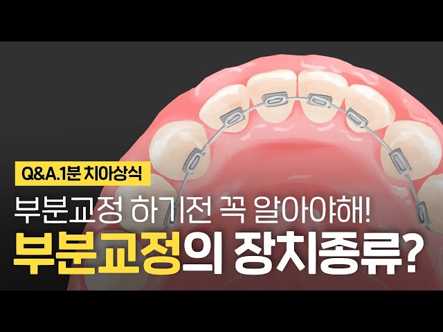 부분교정 교정장치 종류? 앞니 부분치아교정 투명, 설측, 2D, 티끌, MTA 도 가능해! ⏰1분 치아상식!!