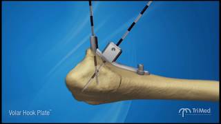 Volar Hook Plate Surgical Animation