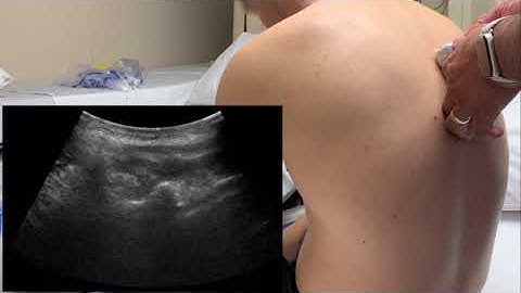 Retrolaminar and Erector Spine